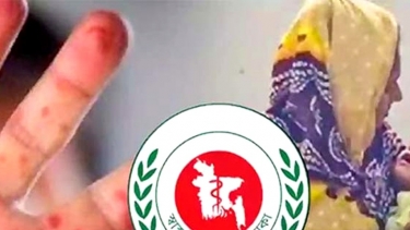 ৫ শিশুর হাম ও উপসর্গে আবারও মৃত্যু